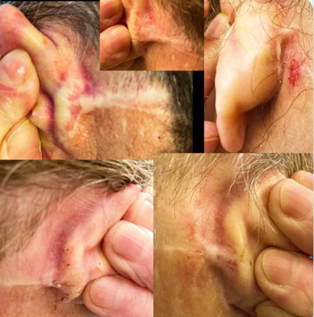 Unlocking the Power of Behind the Ears Sessions: Your Guide to Stage 1 of Megan's Miracle Apitherapy Protocol for Defeating Morgellons Disease